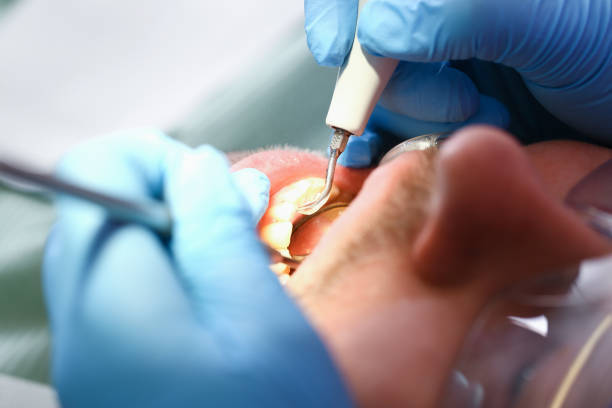 Best Emergency Wisdom Teeth Removal in Burns Flat, OK